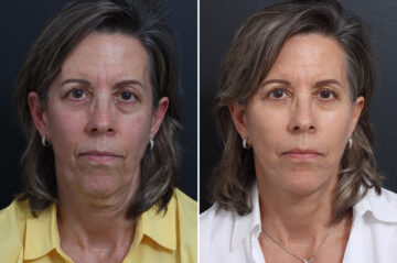 Facelift Before and After Photos in Princeton, NJ, Patient 20237