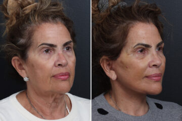 Facelift Before and After Photos in Princeton, NJ, Patient 20240