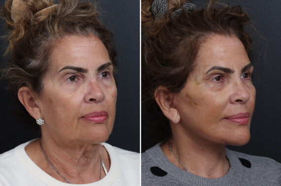 Facelift Before and After Photos in Princeton, NJ, Patient 20240