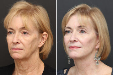 Facelift Before and After Photos in Princeton, NJ, Patient 20246