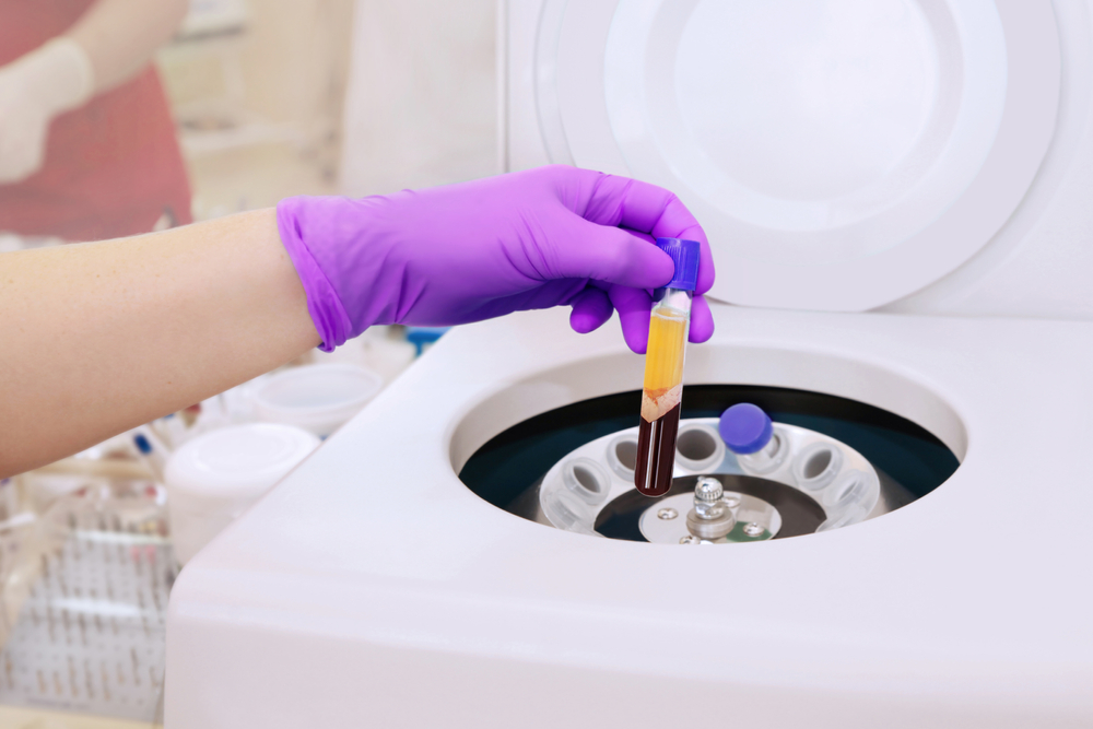 Gloved hand holding PRP tube near centrifuge for platelet-rich plasma facial rejuvenation