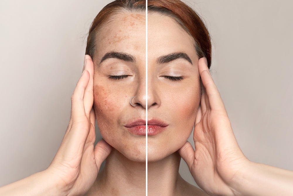 Before-and-after face split beside CO2 laser concerns for wrinkles, sun damage, acne scars, and uneven tone.
