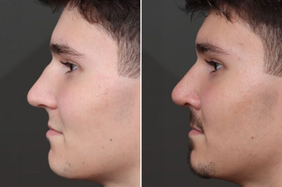 Rhinoplasty Before and After Photos in Princeton, NJ, Patient 19218