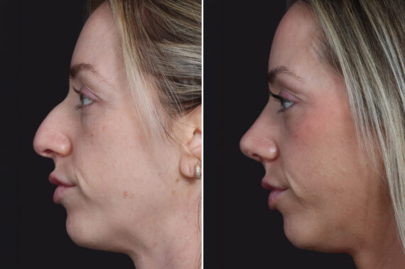 Rhinoplasty Before and After Photos in Princeton, NJ, Patient 19562