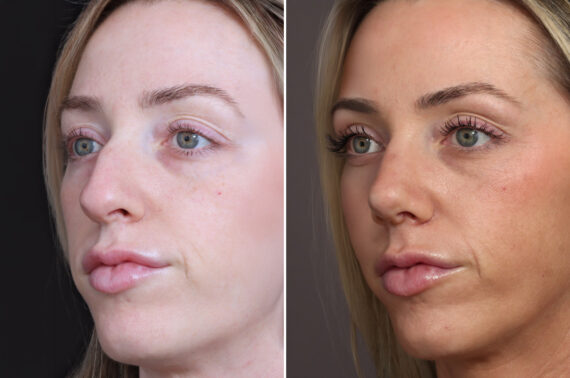 Rhinoplasty Before and After Photos in Princeton, NJ, Patient 19562