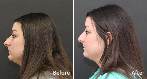 Rhinoplasty Before and After Photos in Princeton, NJ, Patient 7238