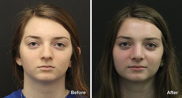 Rhinoplasty Before and After Photos in Princeton, NJ, Patient 7248
