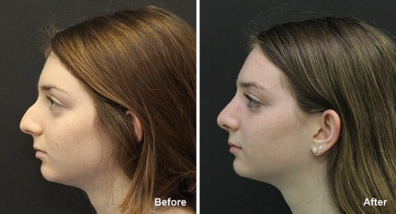 Rhinoplasty Before and After Photos in Princeton, NJ, Patient 7248