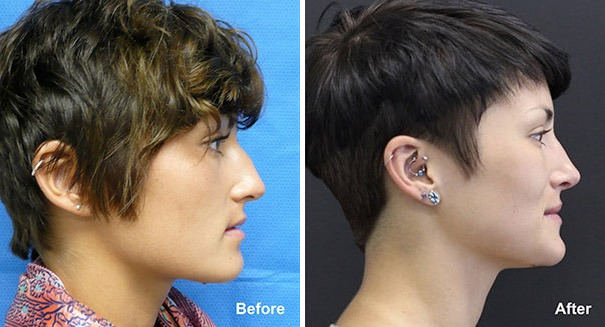 Rhinoplasty Before and After Photos in Princeton, NJ, Patient 7255