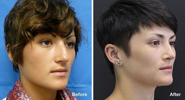 Rhinoplasty Before and After Photos in Princeton, NJ, Patient 7255