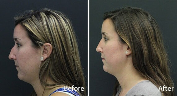 Rhinoplasty Before and After Photos in Princeton, NJ, Patient 7265