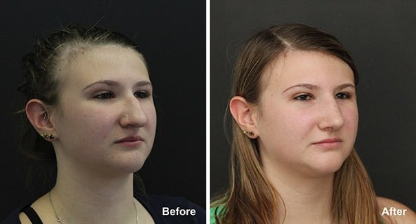 Rhinoplasty Before and After Photos in Princeton, NJ, Patient 7275