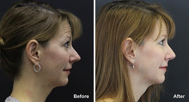 Rhinoplasty Before and After Photos in Princeton, NJ, Patient 7285
