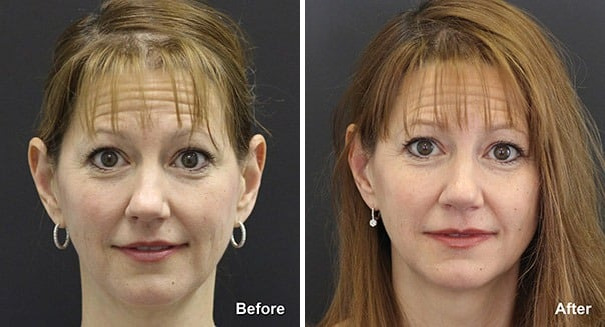 Rhinoplasty Before and After Photos in Princeton, NJ, Patient 7285