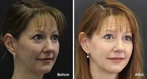 Rhinoplasty Before and After Photos in Princeton, NJ, Patient 7285