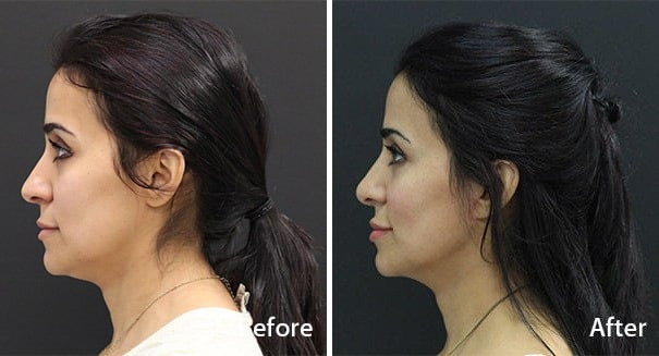 Rhinoplasty Before and After Photos in Princeton, NJ, Patient 7295