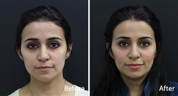 Rhinoplasty Before and After Photos in Princeton, NJ, Patient 7295