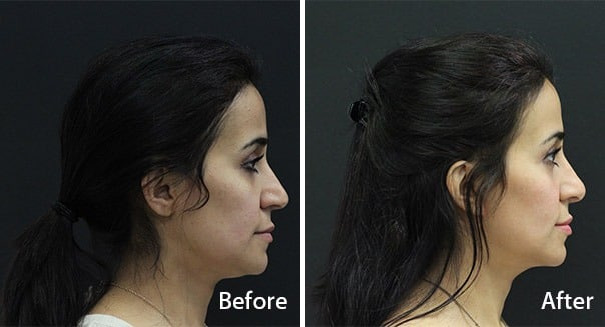 Rhinoplasty Before and After Photos in Princeton, NJ, Patient 7295