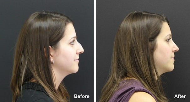 Rhinoplasty Before and After Photos in Princeton, NJ, Patient 7305