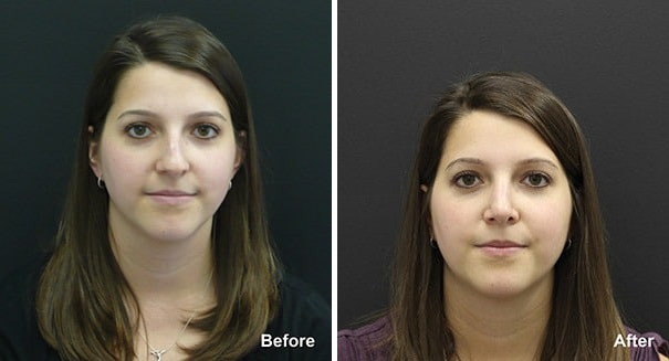 Rhinoplasty Before and After Photos in Princeton, NJ, Patient 7305