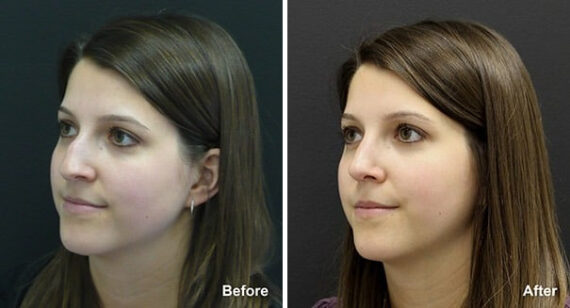Rhinoplasty Before and After Photos in Princeton, NJ, Patient 7305
