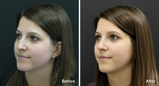 Rhinoplasty Before and After Photos in Princeton, NJ, Patient 7305