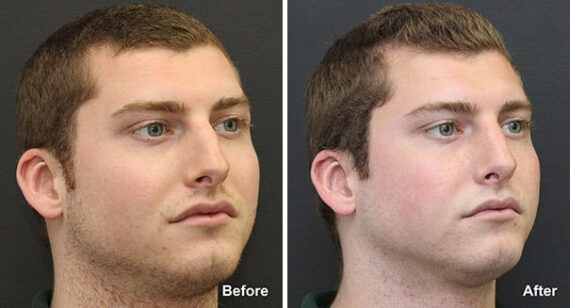 Rhinoplasty Before and After Photos in Princeton, NJ, Patient 7315