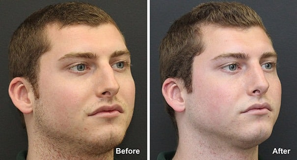Rhinoplasty Before and After Photos in Princeton, NJ, Patient 7315