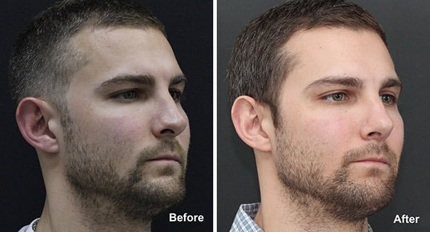 Rhinoplasty Before and After Photos in Princeton, NJ, Patient 7325