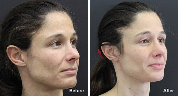 Rhinoplasty Before and After Photos in Princeton, NJ, Patient 7335