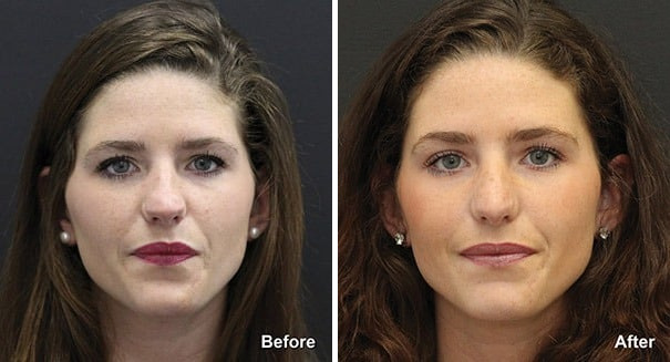 Rhinoplasty Before and After Photos in Princeton, NJ, Patient 7345