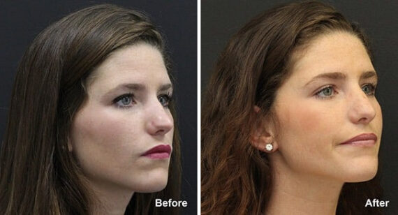 Rhinoplasty Before and After Photos in Princeton, NJ, Patient 7345