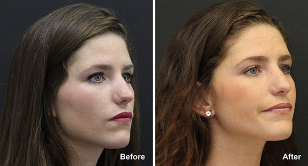 Rhinoplasty Before and After Photos in Princeton, NJ, Patient 7345