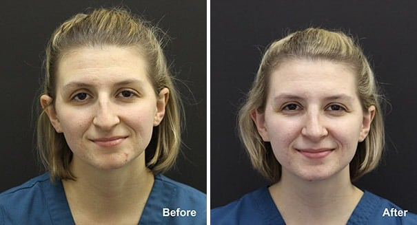 Rhinoplasty Before and After Photos in Princeton, NJ, Patient 7356