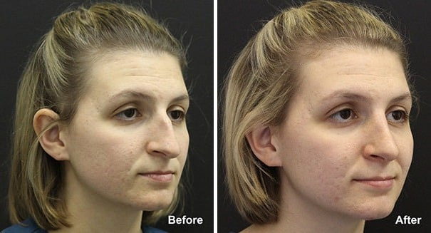 Rhinoplasty Before and After Photos in Princeton, NJ, Patient 7356