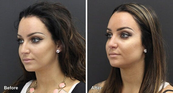 Rhinoplasty Before and After Photos in Princeton, NJ, Patient 7366