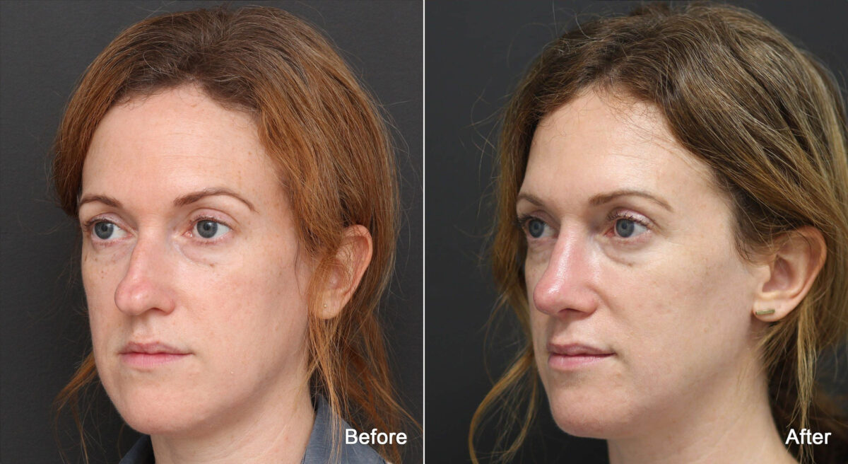 Rhinoplasty Before and After Photos in Princeton, NJ, Patient 8837