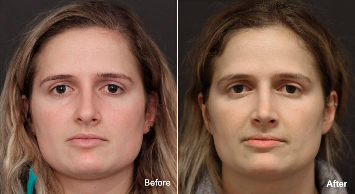 Rhinoplasty Before and After Photos in Princeton, NJ, Patient 8867