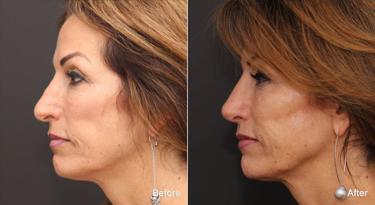 Rhinoplasty Before and After Photos in Princeton, NJ, Patient 8877