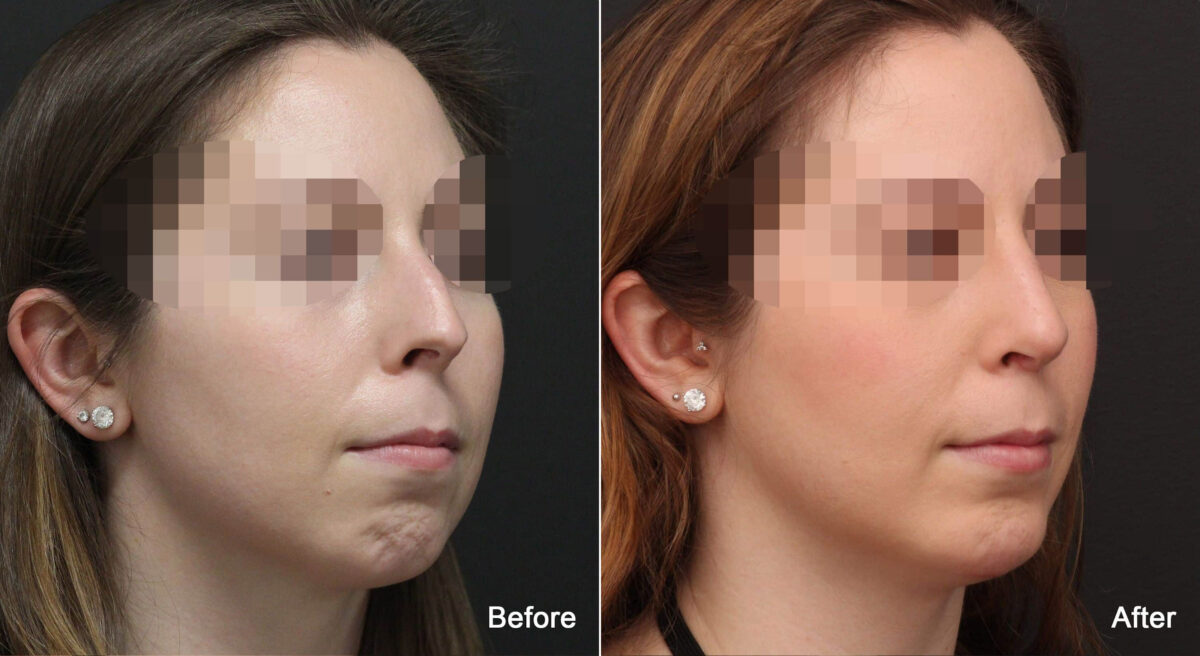 Rhinoplasty Before and After Photos in Princeton, NJ, Patient 8941