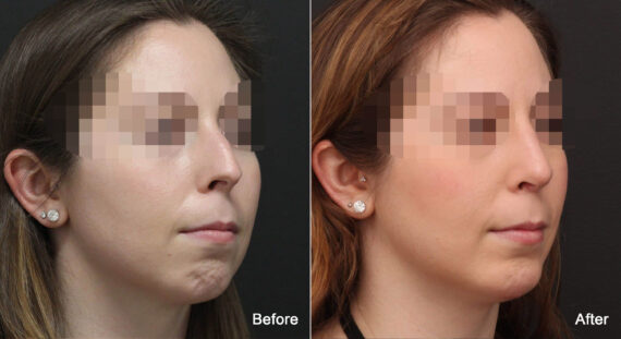 Rhinoplasty Before and After Photos in Princeton, NJ, Patient 8941