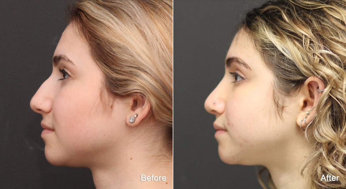 Rhinoplasty Before and After Photos in Princeton, NJ, Patient 9160