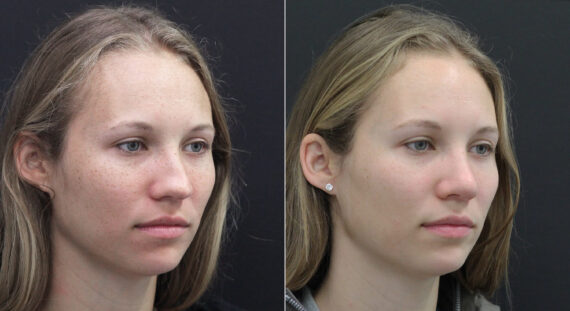 Rhinoplasty Before and After Photos in Princeton, NJ, Patient 9749