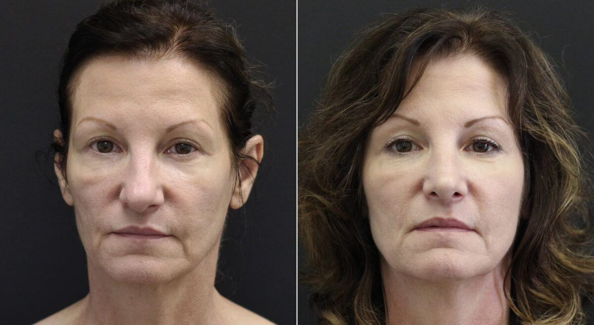 Rhinoplasty Before and After Photos in Princeton, NJ, Patient 9760