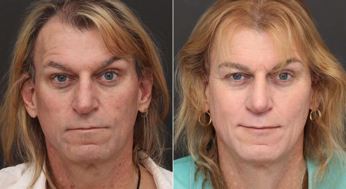 Rhinoplasty Before and After Photos in Princeton, NJ, Patient 9763