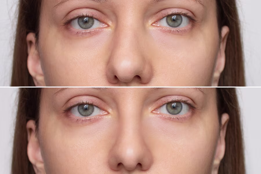 Before-and-after comparison showing a crooked nose appearing straighter and more centered.
