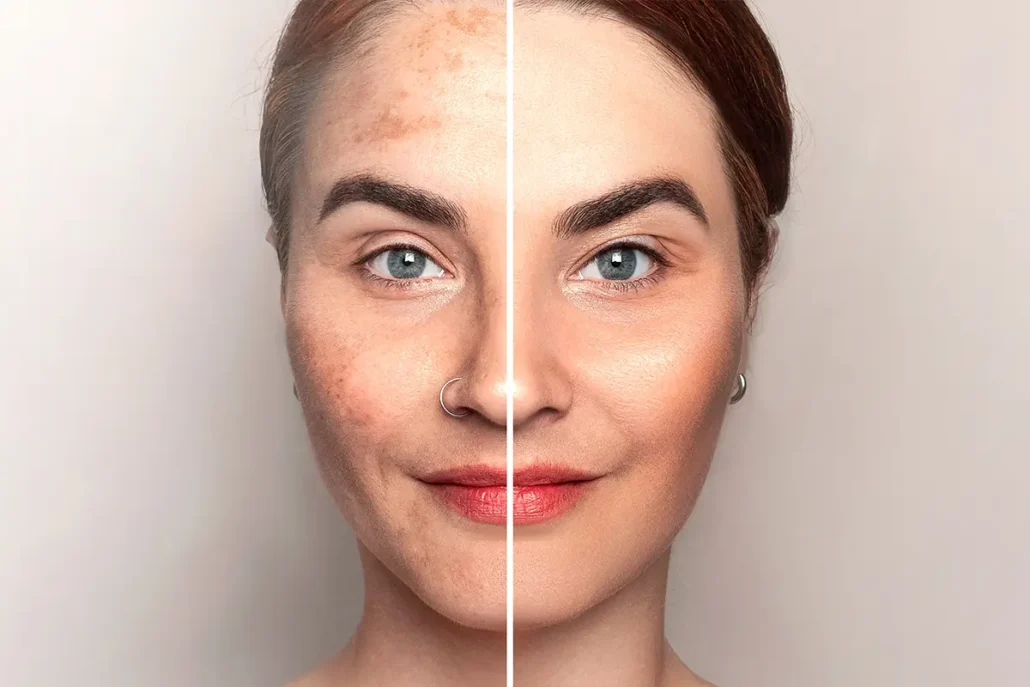 Split-face image showing uneven skin tone and smoother-looking skin.