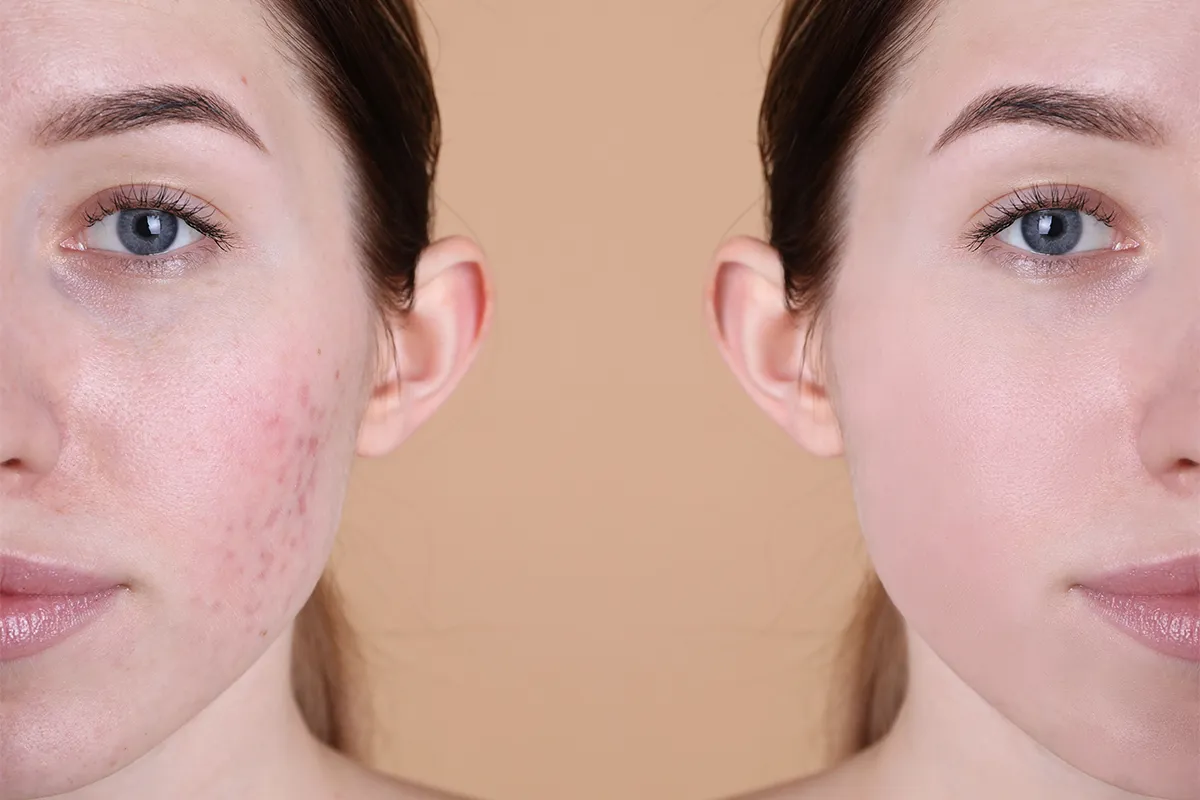 Side-by-side facial image showing acne scarring and smoother-looking skin.