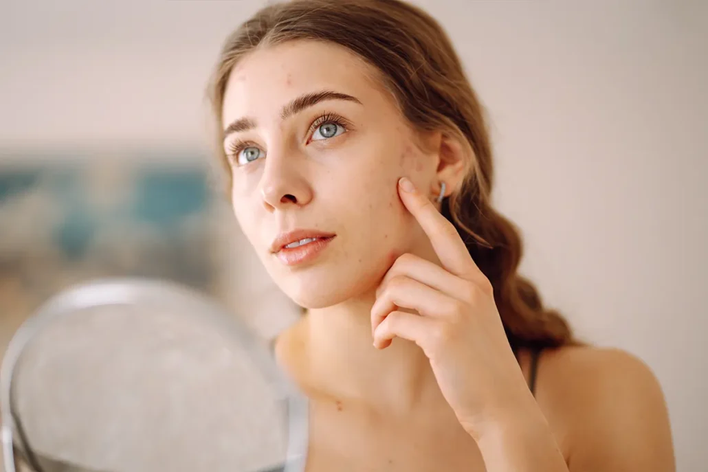 Woman pointing to acne marks and uneven texture on her cheek.