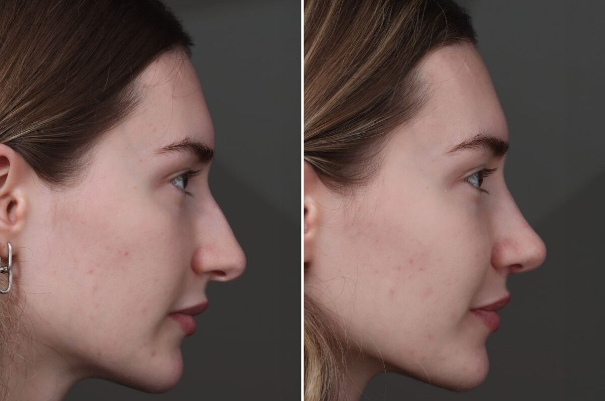 Rhinoplasty Before and After Photos in Princeton, NJ, Patient 19487